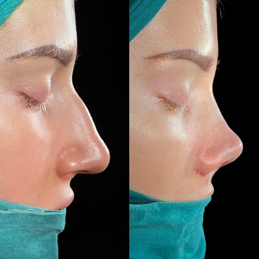 Face Aesthetic in Turkey