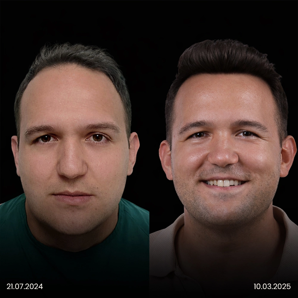 Hair Transplant in Turkey